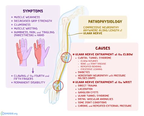 Ulnar Nerve Entrapment Peripheral Nerve Ulnar Nerve Exercises Nerve