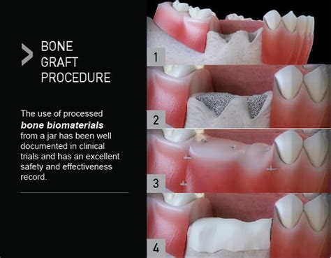 Bone Grafting Procedure Dental News Network
