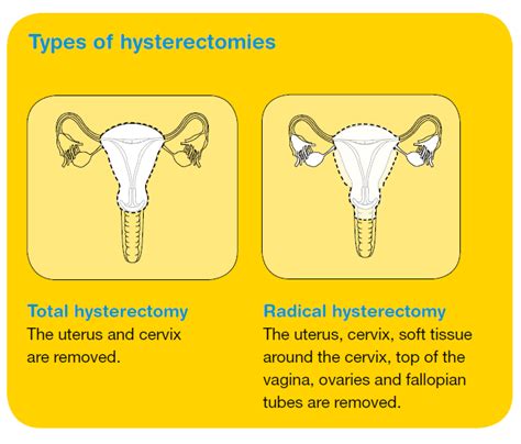 Cervical cancer, or cancer of the cervix, begins on the surface of the cervix. Cervical cancer treatment | Cancer Council Victoria