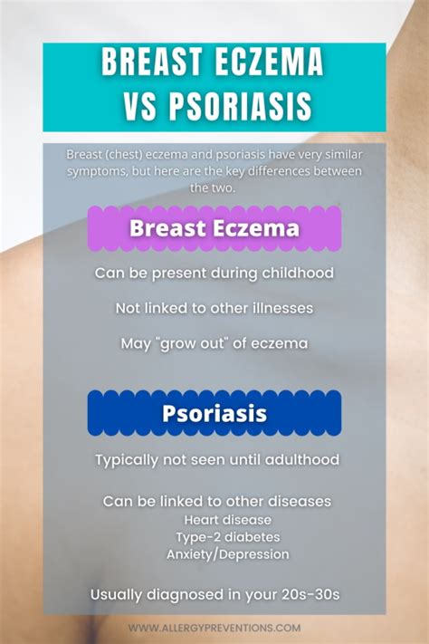 Breast Eczema Vs Psoriasis Infographic 5 26 Allergy Preventions