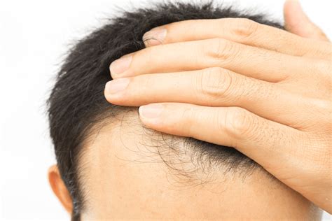 When Do The Hair Grow Back After A Hair Transplant Hair Implant Singapore