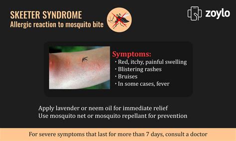 Skeeter Syndrome Allergic Reaction To Mosquito Bite Mosquito Bite