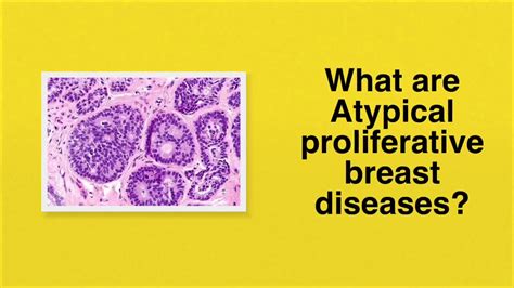 Atypical Ductal And Lobular Hyperplasia Of Breast Youtube