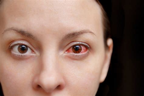 Pink Eye Conjunctivitis 3 Home Remedies That Help