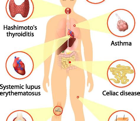 Autoimmune Disease The Johns Hopkins Patient Guide To Diabetes