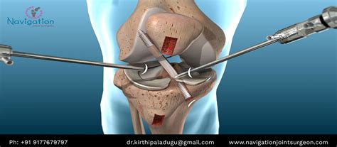 We did not find results for: Arthroscopy ACL surgery is keyhole surgery to replace or ...