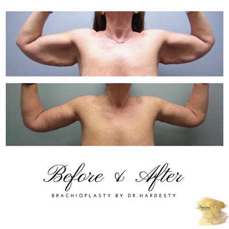 Brachioplasty Aka Arm Lift Before And After Body Contouring Excess
