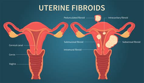 Uterine Fibroids Uf Health