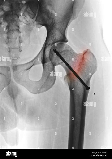Hip X Ray Showing The Repair Of A Fractured Femur With A Screw Stock