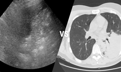 Covid 19 Imaging Lung Ultrasound Vs Chest Ct • Healthcare In