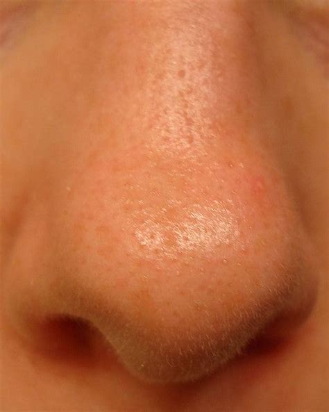 How Can I Unclog Pores On My Nose Futurederm Nose Pores Clean