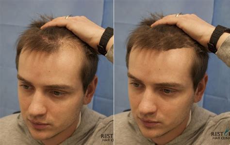 We did not find results for: A hybrid toupee for V shaped loss? - BaldTruthTalk.com
