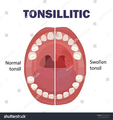 215 Tonsils Stone Images Stock Photos And Vectors Shutterstock