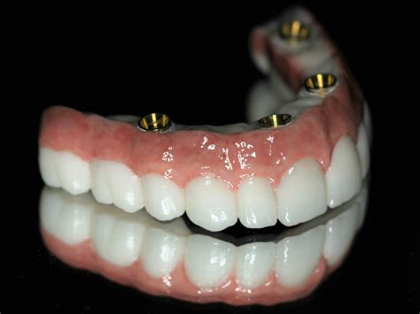 Is It Possible To Start Over With Full Mouth Dental Implants