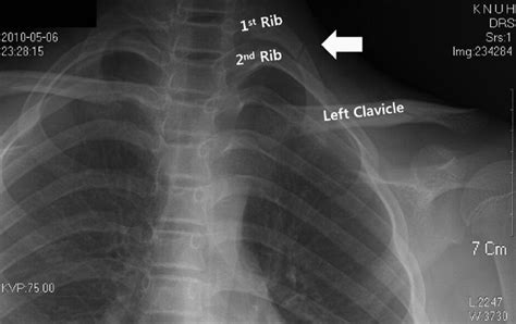 Juvenile First Rib Fracture Caused By Morning Stretching Journal Of Emergency Medicine