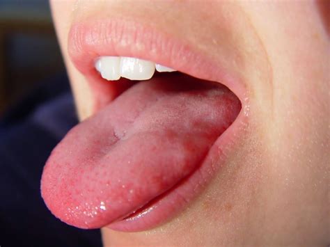 5 Early Symptoms Of Tongue Cancer Ebuddynews