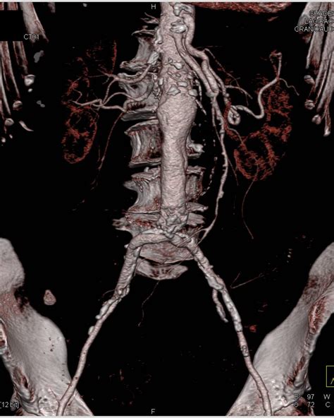 Abdominal Aortic Aneurysm Vascular Case Studies Ctisus Ct Scanning