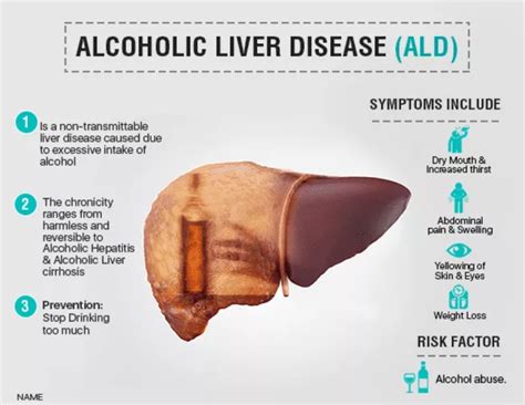 Understanding Alcoholic Hepatitis Causes Symptoms And Prevention