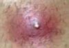 The best way to fight infection once it occurs is with the application of steroid cream on the area. Ingrown Facial Hair: Cyst, Bump, Deep Infection, Causes ...
