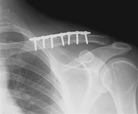 Surgical Repair Of A Clavicle Fracture Collarbone