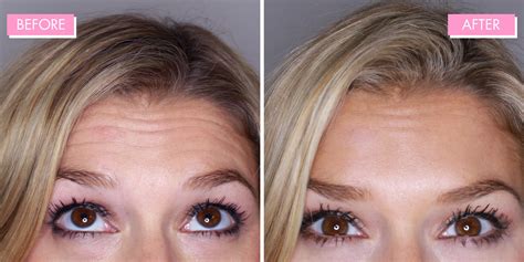 How does botox treat headaches? How long before botox takes effect ONETTECHNOLOGIESINDIA.COM
