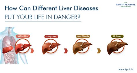 How Can Different Liver Diseases Put Your Life In Danger Tpaf