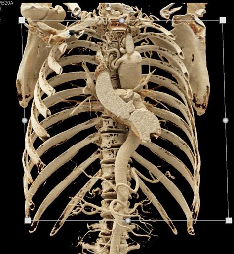 Coarctation Of The Aorta With Multiple Collaterals Chest Case Studies