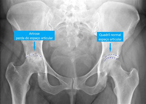A Radiografia Do Quadril Com Artrose