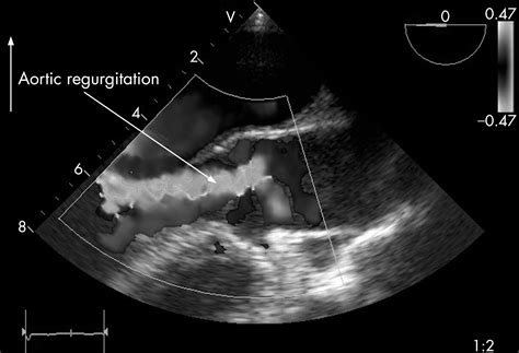 Quadricuspid Aortic Valve A Rare Cause Of Aortic Insufficiency Heart