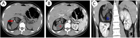 Frontiers Rare Primary Adrenal Tumor A Case Report Of Teratomas And