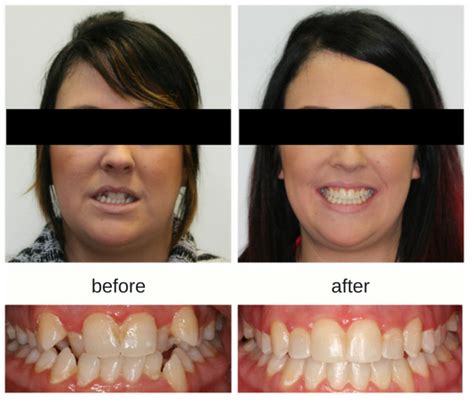 Invisalign Jaw Alignment Before And After Before And After