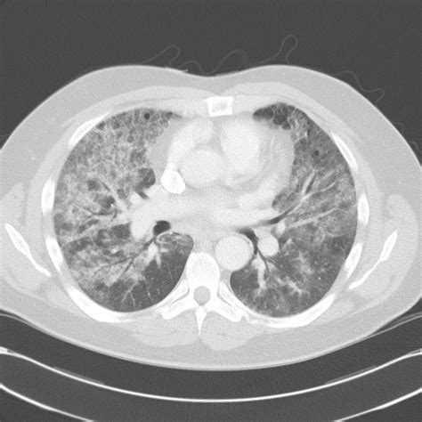 Pneumocystis Jirovecii Pneumonia Image