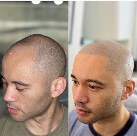 Scalp Micropigmentation Before And After Pictures