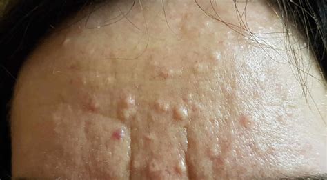 Tiny Bumps Under Skin On Face And Neck Diagram White Raised Bumps On
