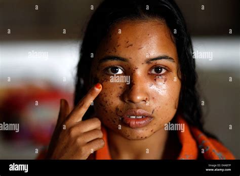 kustia bangladesh 7th july 2014 a 18 year old girl sonia akter suffers from acid attacks