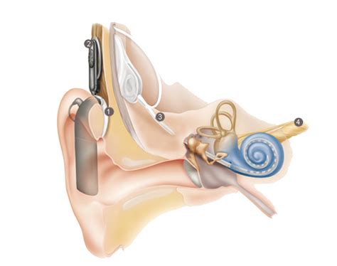 Hearing Aid Cochlear Implant Services Faith Hearing Specialists