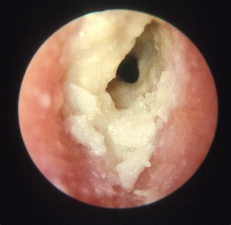 A Fungal Infection Of The External Auditory Canal Is Logmyte