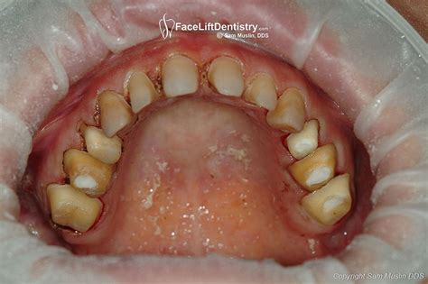Aug 06, 2020 · as you'll see in the teeth diagram, by the time your child is 3, she should have all of her baby teeth, which includes: What is a VENLAY