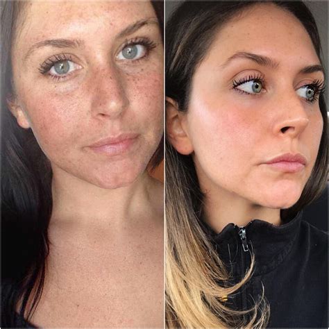 My Experience With Laser Treatment For Rosacea Including Before After