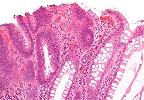 Tratamiento quirúrgico de un adenoma pleomorfo nasal cirujano: Adenoma Tubular: Tipos, Síntomas y Tratamiento - Lifeder