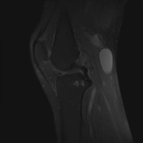 Mri Of The Knee Showing A Popliteal Cyst Marked By The White Arrow Download Scientific