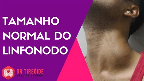 Qual é o tamanho normal do linfonodo Dr Jônatas Catunda de Freitas YouTube
