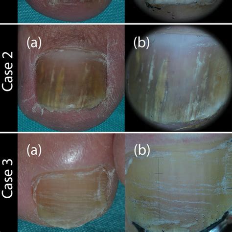 Dermoscopic Patterns Of Onychomycosis Dermoscopic Patterns With