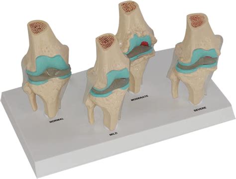 Amazon Com Wsxka Human Knee Joint Model Four Stages Of Human Anatomy
