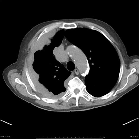 Mesothelioma Pleura Ct 29 28 Axial Ct Scan Of A Patient With A Right