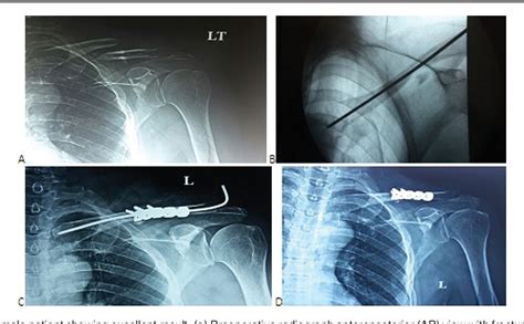 Figure 1 From Dual Fixation Of Midshaft Clavicle Fractures In Adults