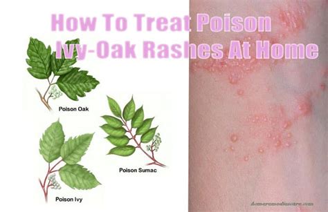 15 Reliable Home Remedies To Get Rid Of Poison Ivyoaksumac Rashes