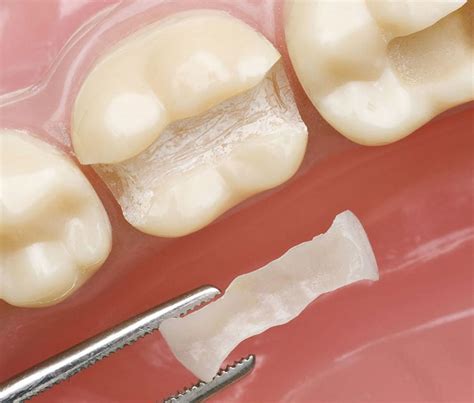 Dental Inlay Dental Onlay Indirect Restoration Vancouver