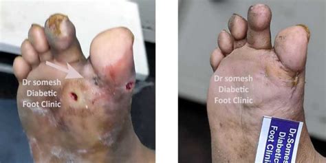 Diabetes Foot Gangrene Stages St Metatarsal Head Region Podiatry Doctor