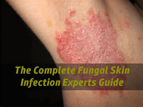 Types Of Fungal Skin Infections
